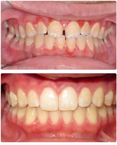 Invisalign Before & After in Waynesville, NC | Smoky Mountain Dentistry